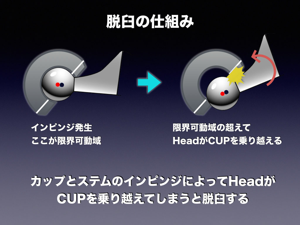 脱臼肢位の認識の違い 整形外科のいろいろ