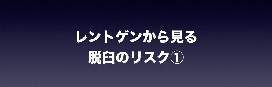 レントゲンから見る脱臼のリスク 1