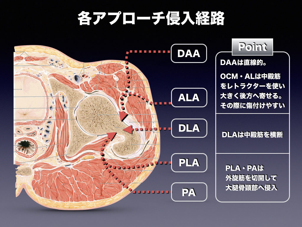 Thaアプローチ別 侵入経路 整形外科のいろいろ