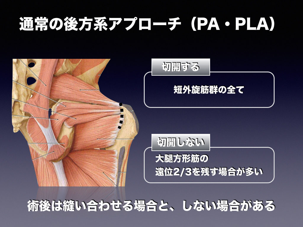 短外旋筋温存アプローチ Erp 整形外科のいろいろ