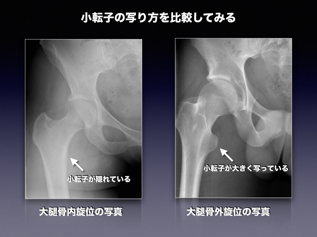 レントゲン撮影の肢位について │ 整形外科のいろいろ