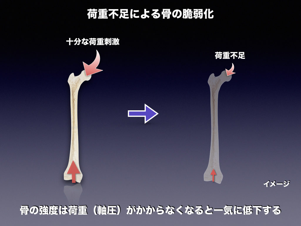 応力遮蔽 Stress Shielding とは 整形外科のいろいろ