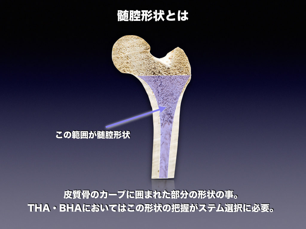 大腿骨の髄腔形状 Dorrの分類 整形外科のいろいろ