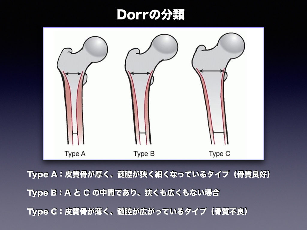 Dorrの分類とは
