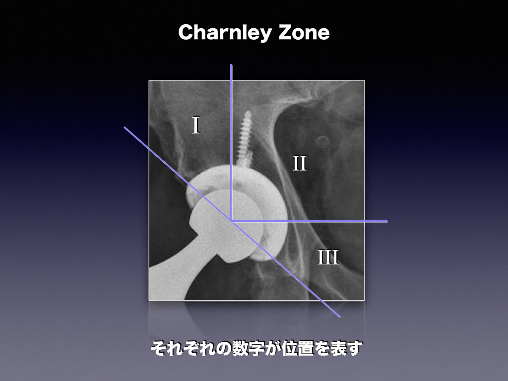 Hip Prosthesis ZoneのCharnley Zone（THA）