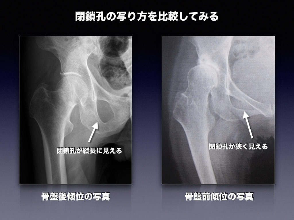 閉鎖骨の比較（股関節レントゲン）