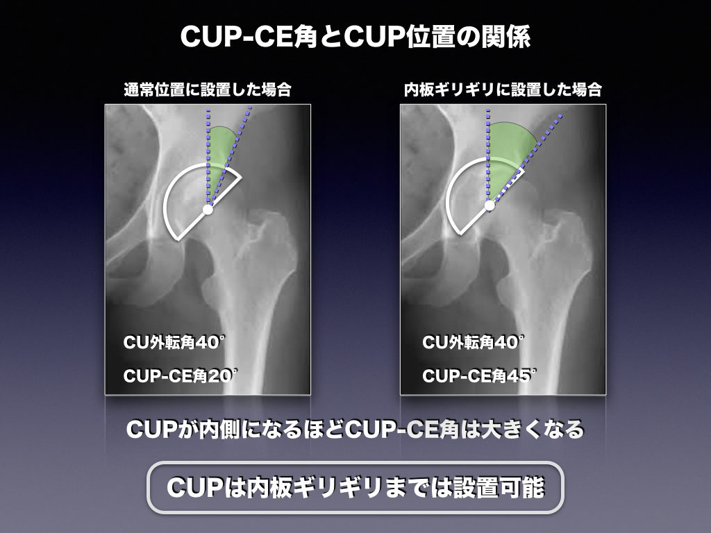 CUP-CE角とCUP位置の関係