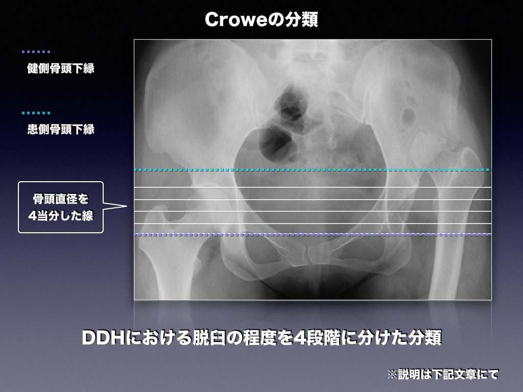 Croweの分類　股関節脱臼の程度分類