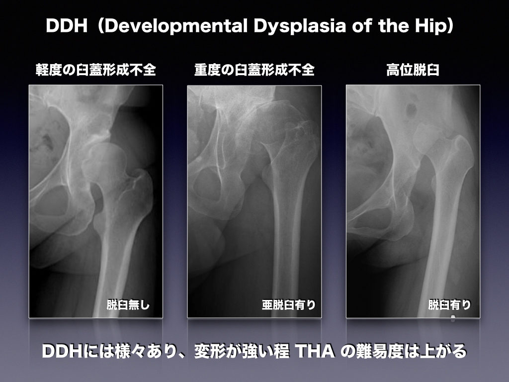 Ddhとは 整形外科のいろいろ