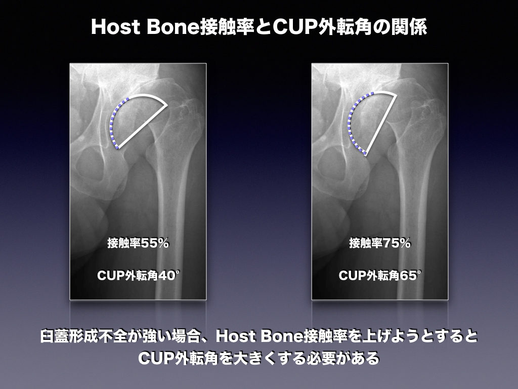 Host Bone接触率とCUP外転角の関係