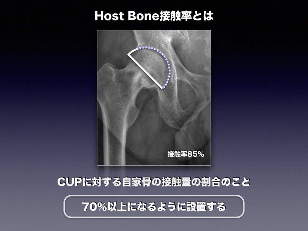 Host Bone接触率とは