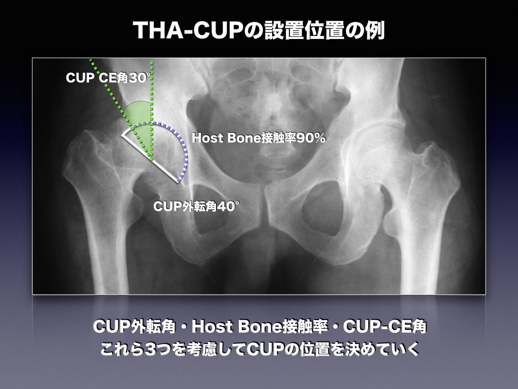 THA-CUPの設置例。条件を満たしているか？