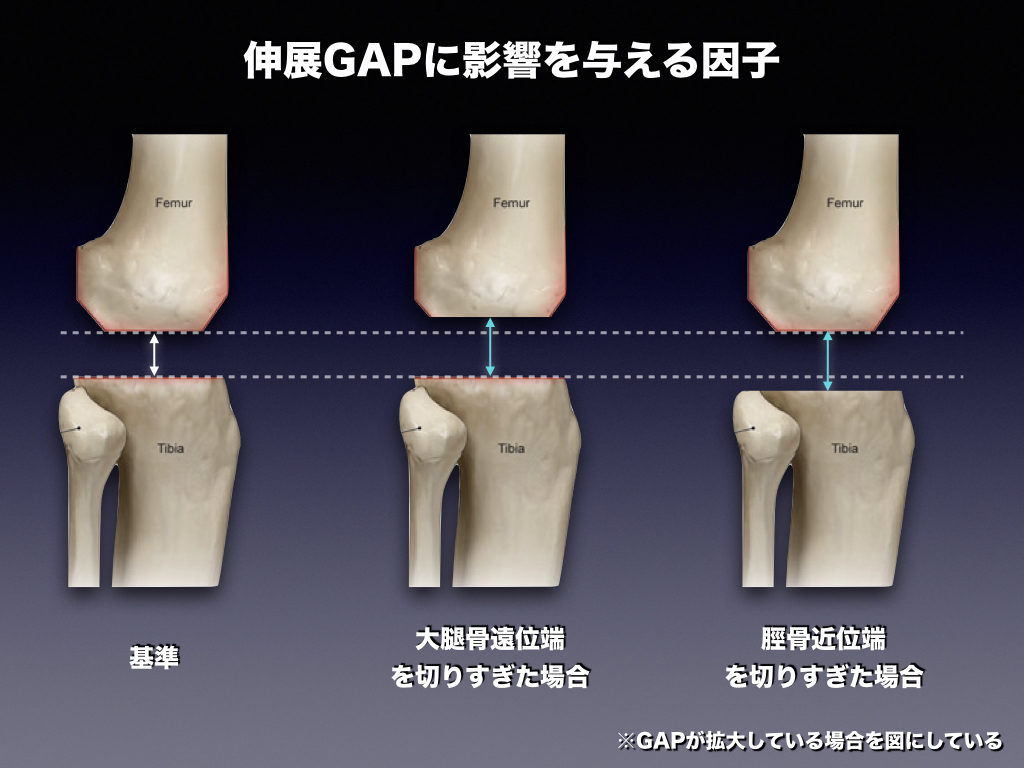 関節gapは何で変化する 整形外科のいろいろ