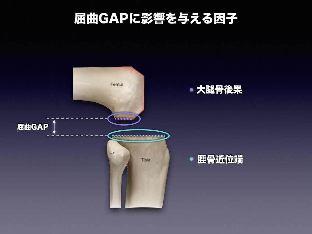 関節gapは何で変化する 整形外科のいろいろ